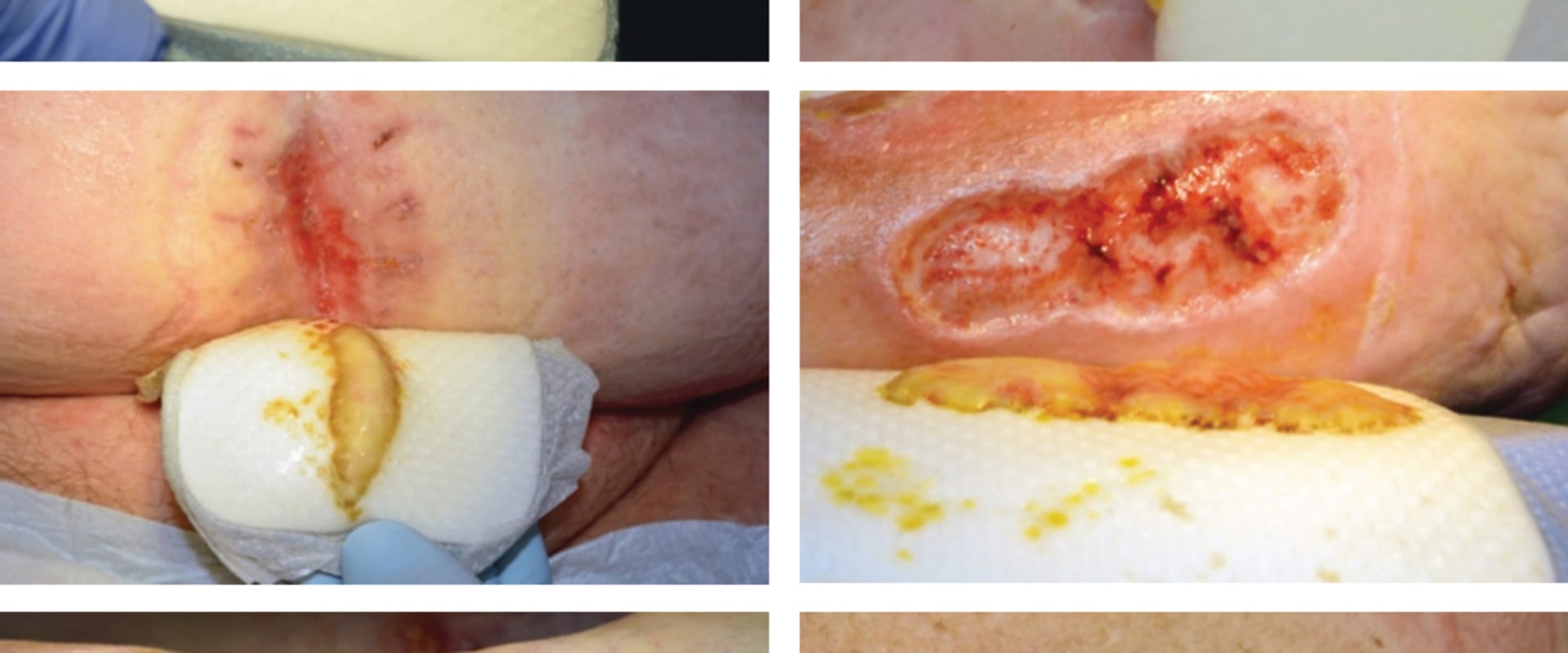 The Importance of Assessing and Documenting Wound Exudate Characteristics