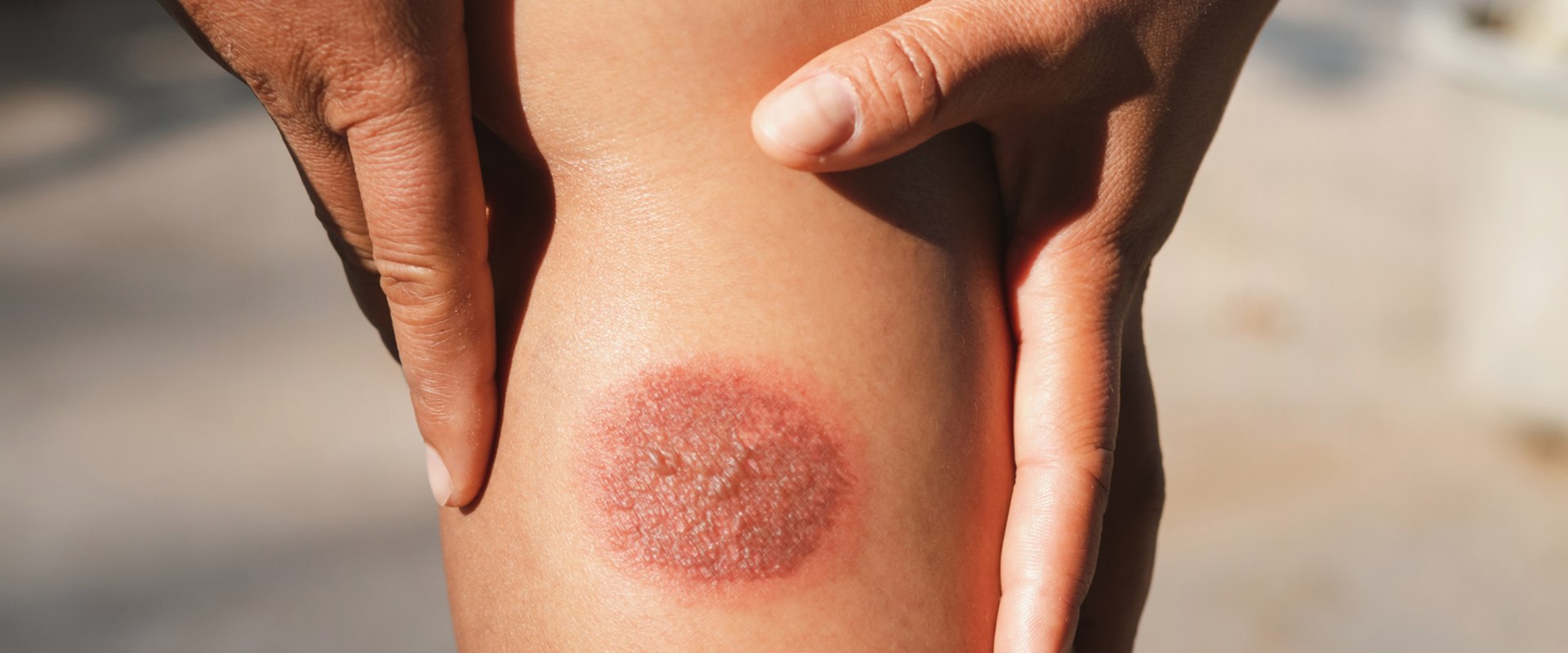 The Essentials Of 2nd Degree Burn Blister Healing Stages In Wound Management