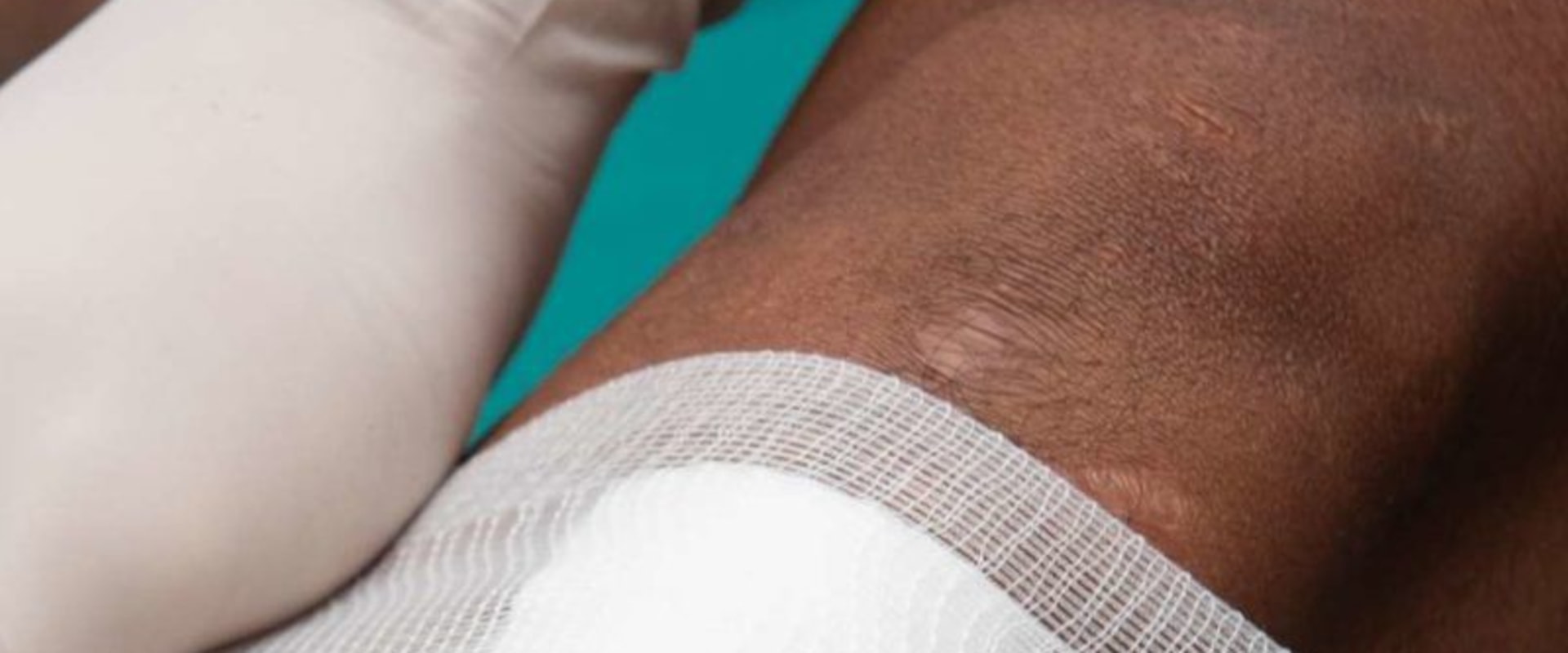 The Importance of Proper Wound Care: A Comprehensive Guide