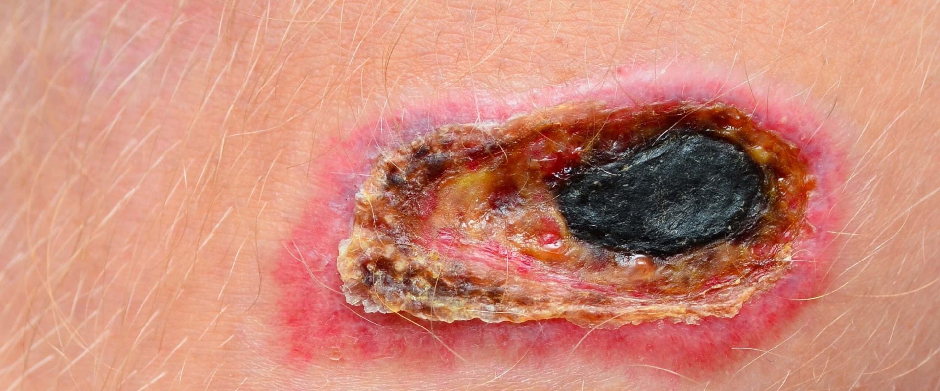 Managing Your Wound: What Does Necrotic Tissue Look Like And Why It Matters