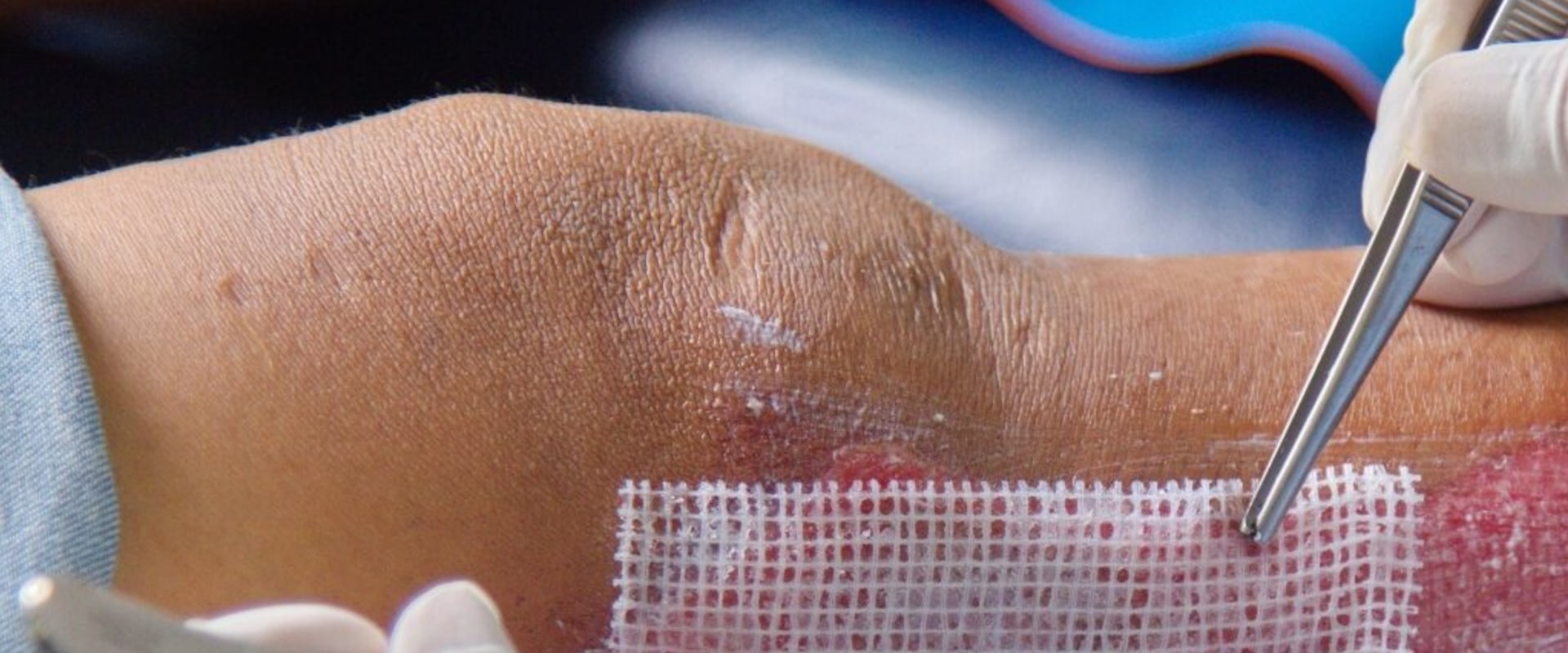 Granulation Tissue Pictures: Visual Guide to Wound Healing, Proper Care Tips, and How to Promote Faster Skin Regeneration