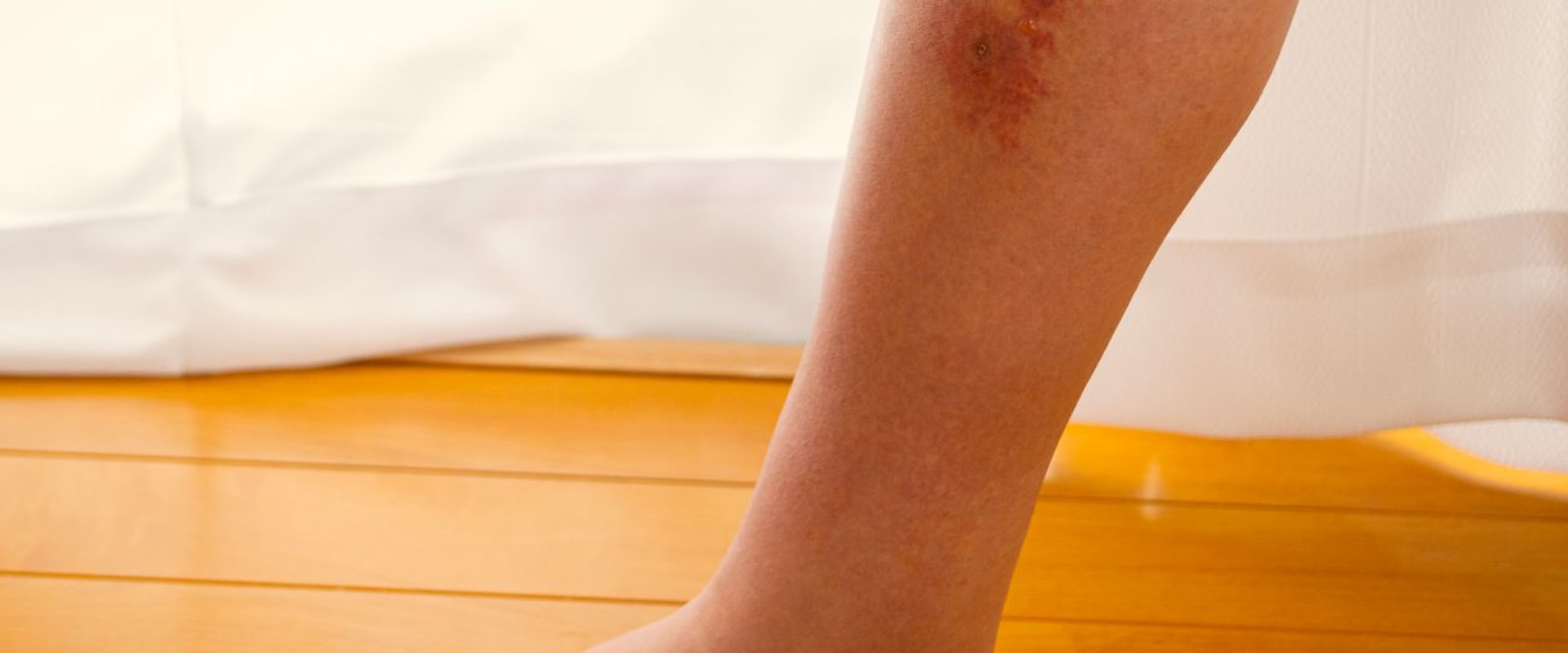 Effective Wound Management Strategies After A Cellulitis Diagnosis Of The Lower Limb