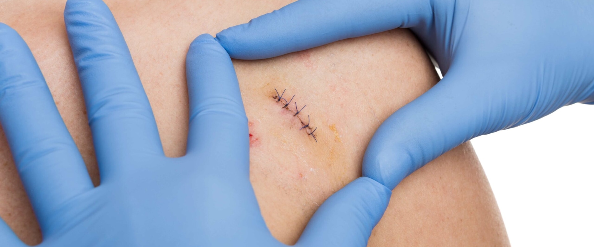 How to Manage Wounds Effectively Through Normal Stitches Healing Stages