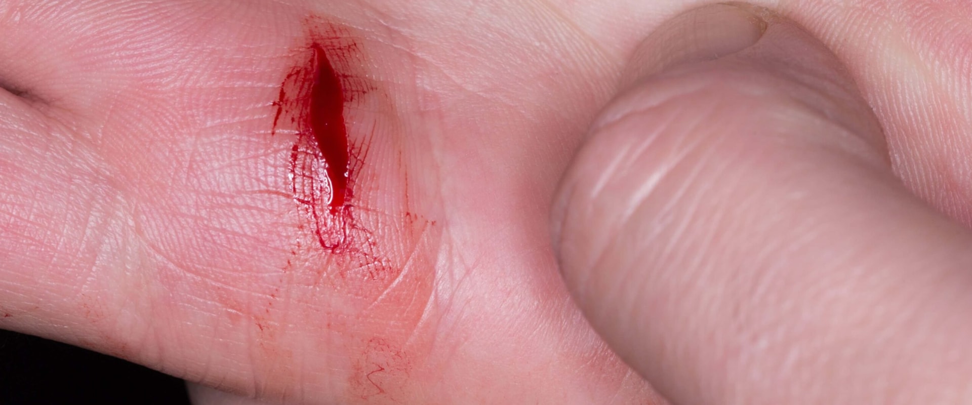 Expert Tips for Speeding Up Wound Healing