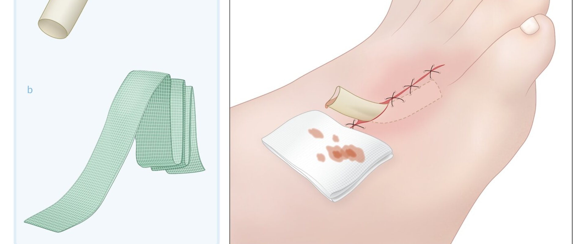 Why A Macerated Skin Wound Needs Immediate Attention In Wound Management