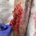 How to Treat a Skin Avulsion Wound and Ensure Optimal Healing