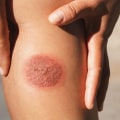 The Essentials Of 2nd Degree Burn Blister Healing Stages In Wound Management