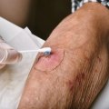 Effective Edema Wound Management: How To Heal And Prevent Complications