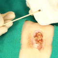 How Silver Nitrate On Skin Wounds Revolutionizes Wound Management