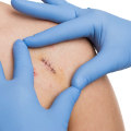 How to Manage Wounds Effectively Through Normal Stitches Healing Stages