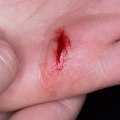 Expert Tips for Speeding Up Wound Healing