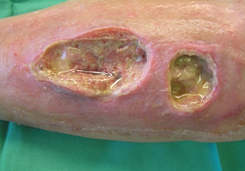 The Intricate Process of Wound Healing: Uncovering the Triggers