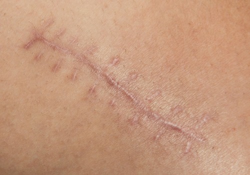 The Science Behind Speeding Up Wound Healing