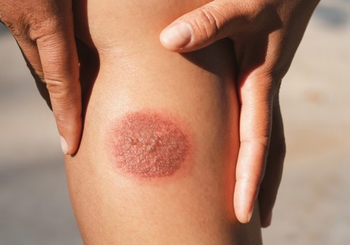 The Essentials Of 2nd Degree Burn Blister Healing Stages In Wound Management