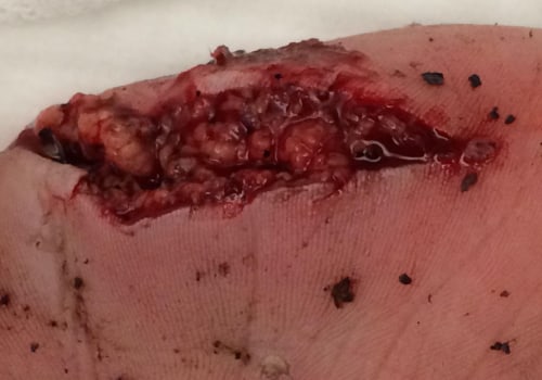 8 Key Principles for Effective Wound Management