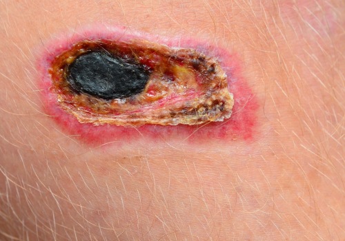 Managing Your Wound: What Does Necrotic Tissue Look Like And Why It Matters