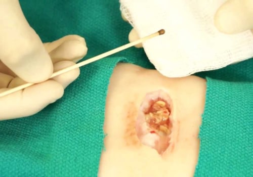 How Silver Nitrate On Skin Wounds Revolutionizes Wound Management