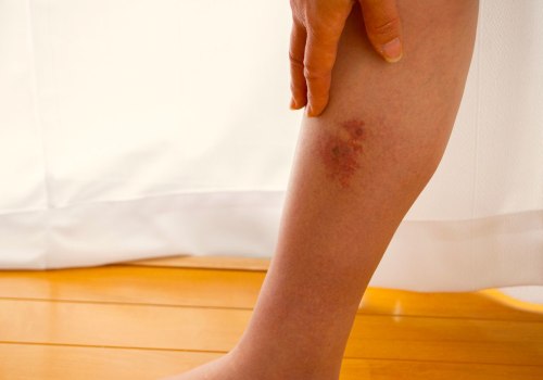 Effective Wound Management Strategies After A Cellulitis Diagnosis Of The Lower Limb