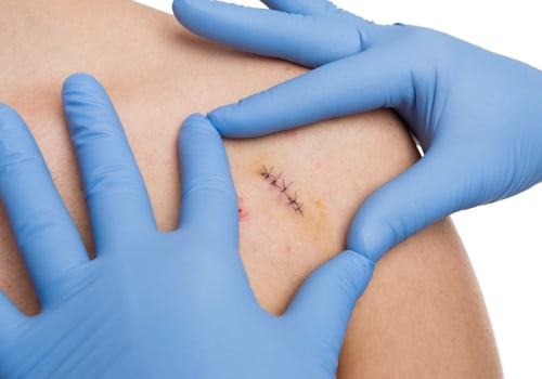 How to Manage Wounds Effectively Through Normal Stitches Healing Stages