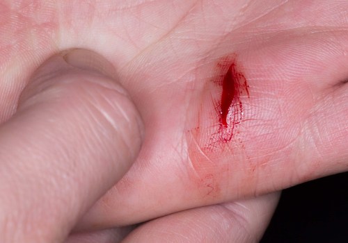 Expert Tips for Speeding Up Wound Healing