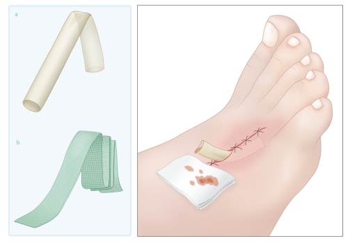 Why A Macerated Skin Wound Needs Immediate Attention In Wound Management