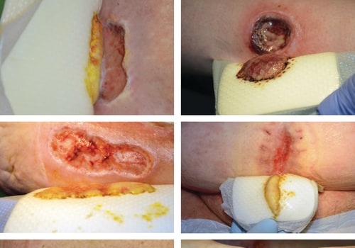 The 4 Stages of Wound Healing: An Expert's Perspective